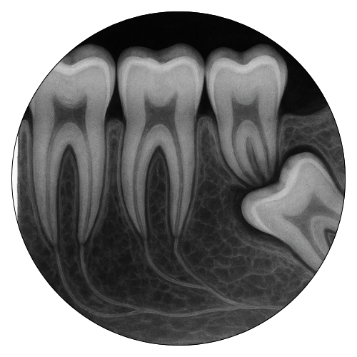Root Canal Treatment, Best Dentist in Zirakpur 
