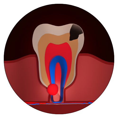 Root Canal Treatment, Best Dentist in Zirakpur 