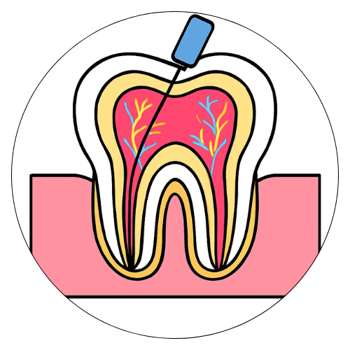 Root Canal Treatment, Best Dentist in Zirakpur 